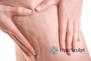 CoolSculpting for Legs: The Innovative Approach to Redefining Your Legs 5 Start your journey today book your coolsculpting treatment Royal Tunbridge Wells online today!