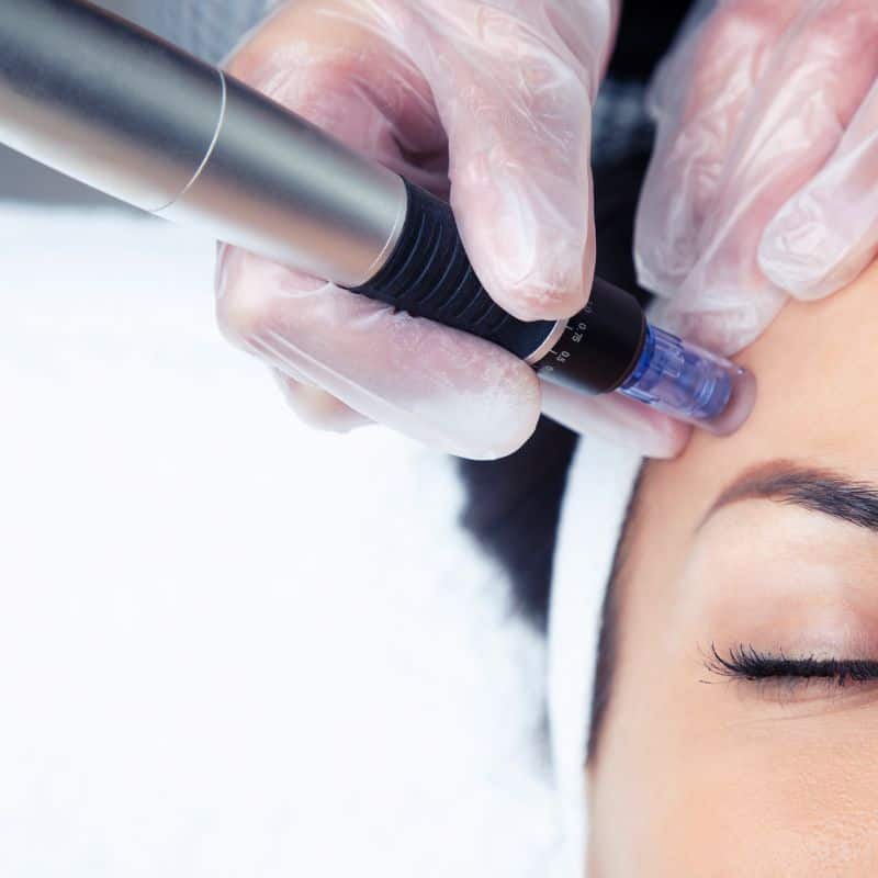 Morpheus8 treatment Royal Tunbridge Wells from Lipo Sculpt - Book in today!
